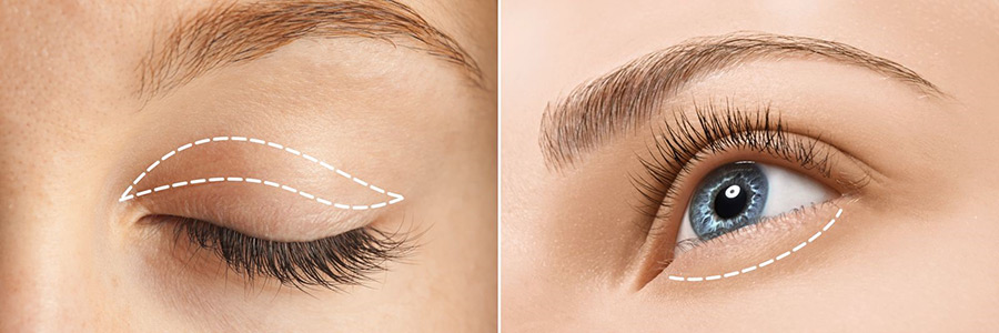 Cosmetic Blepharoplasty Cosmetic Blepharoplasty