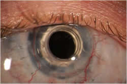 Eye Close Up After Artificial Corneal Transplant Surgery