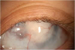 Eye Close Up Before Artificial Corneal Transplant Surgery