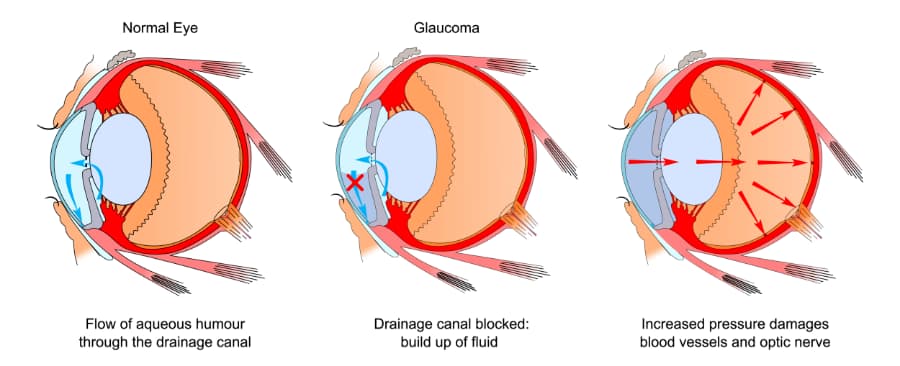 Glaucoma Dev
