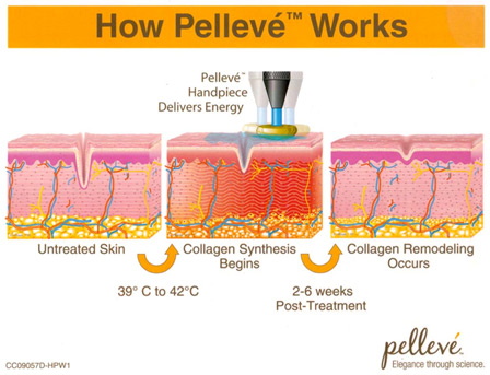 How Pelleve Works