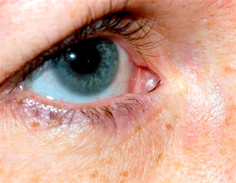 Jones Tube Ophthalmic Consultants of Vermont