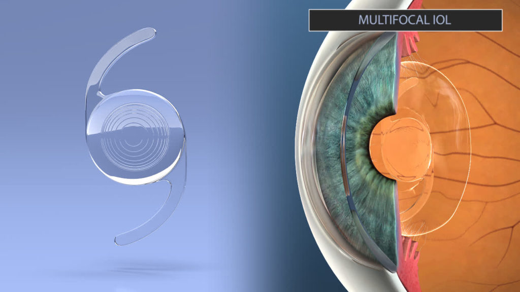 Selecting An Intraocular Lens IOL Ophthalmic Consultants Of Vermont