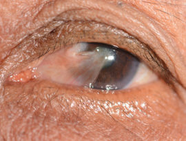 Pterygium Excision - Ophthalmic Consultants of Vermont