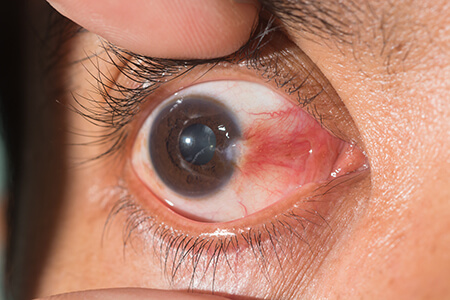 Pterygium