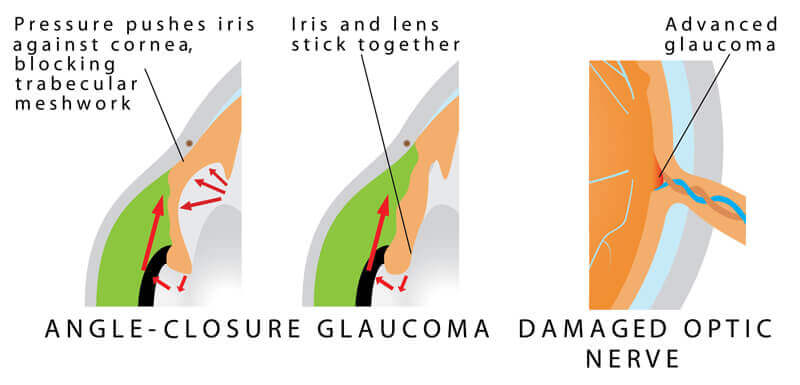 Narrow Angle Glaucoma Diagram