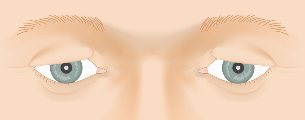 Droopy Eyelids Diagram
