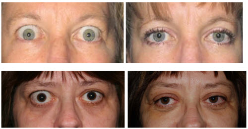 Thyroid Eye Disease - Ophthalmic Consultants of Vermont