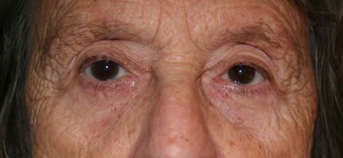 Ptosis Patient 1 After