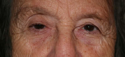Ptosis 1 Before
