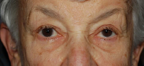 Ptosis Patient 2 After