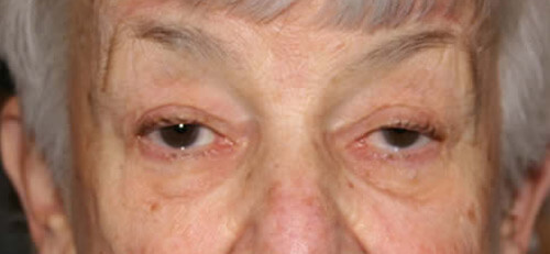 Ptosis Patient 2 Before