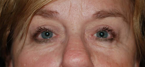 Ptosis Patient 3 After
