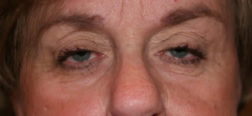 Ptosis Patient 3 Before