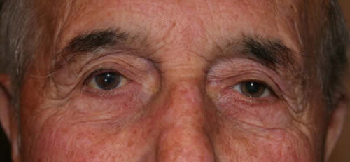 Ptosis Patient 4 After
