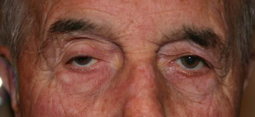Ptosis Patient 4 Before